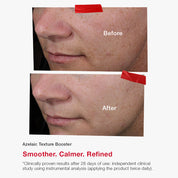 Azelaic Texture Booster